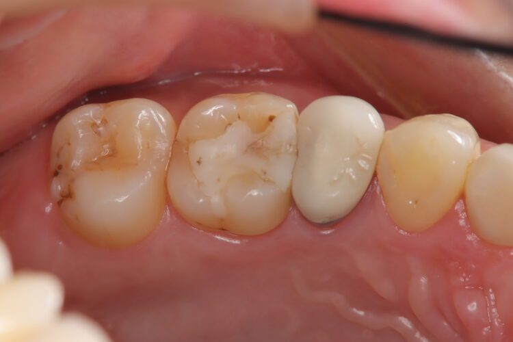 定期健診で発見した虫歯をセラミックで修復 治療前画像