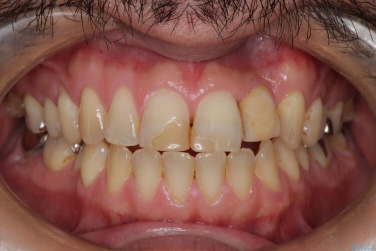 歯をほぼ削らない！接着ブリッジとホワイトニングで自然な笑顔へ 治療前画像