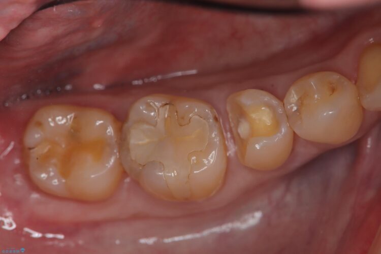 即日セラミック修復でメタルフリー 治療途中画像