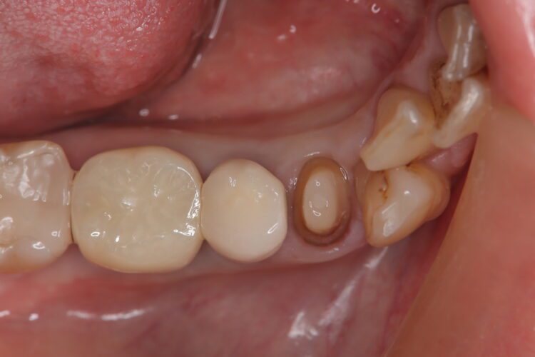 フロスがちぎれて取れない　他院で治療した歯の凹みを改善 治療途中画像
