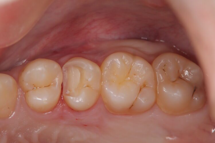 虫歯で穴のあいた歯 セラミックで修復 治療途中画像
