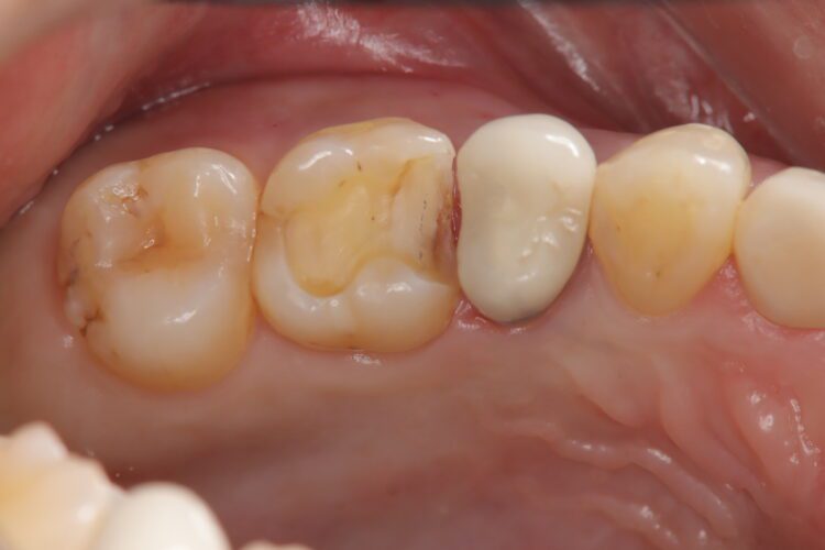 定期健診で発見した虫歯をセラミックで修復 治療途中画像