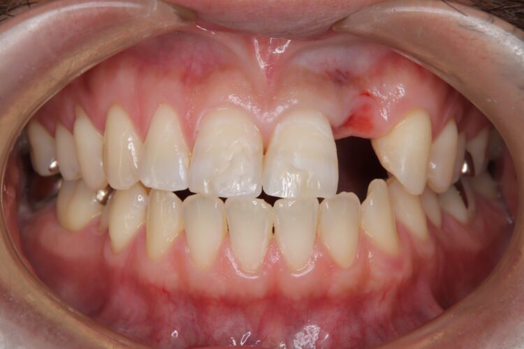 歯をほぼ削らない！接着ブリッジとホワイトニングで自然な笑顔へ 治療途中画像