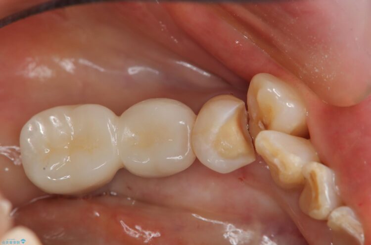 乱ぐい歯の虫歯治療 治療途中画像