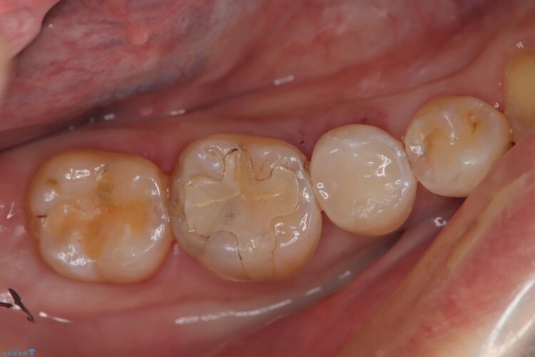 即日セラミック修復でメタルフリー アフター