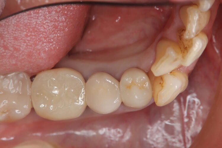 フロスがちぎれて取れない　他院で治療した歯の凹みを改善 治療後画像