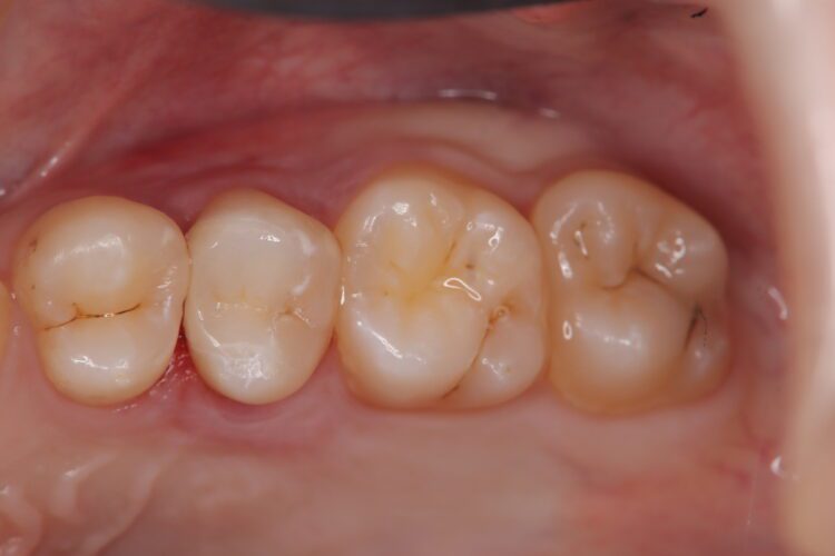 虫歯で穴のあいた歯　セラミックで修復 アフター