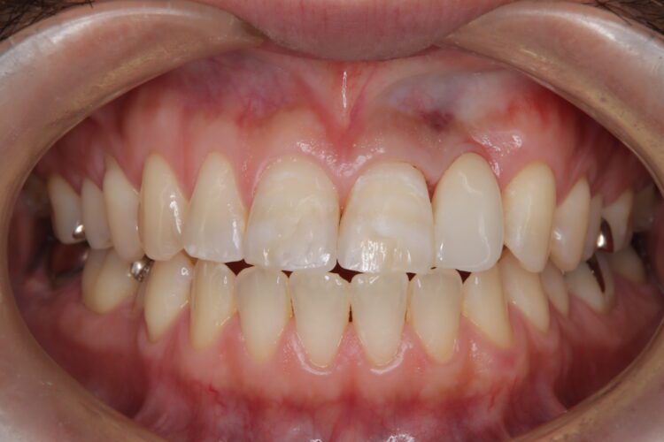 歯をほぼ削らない！接着ブリッジとホワイトニングで自然な笑顔へ 治療後画像