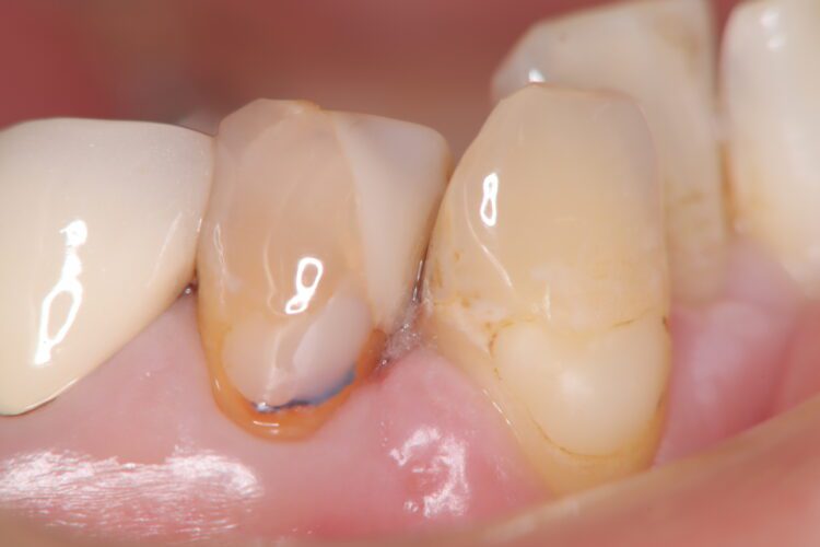フロスがちぎれて取れない　他院で治療した歯の凹みを改善 治療前画像