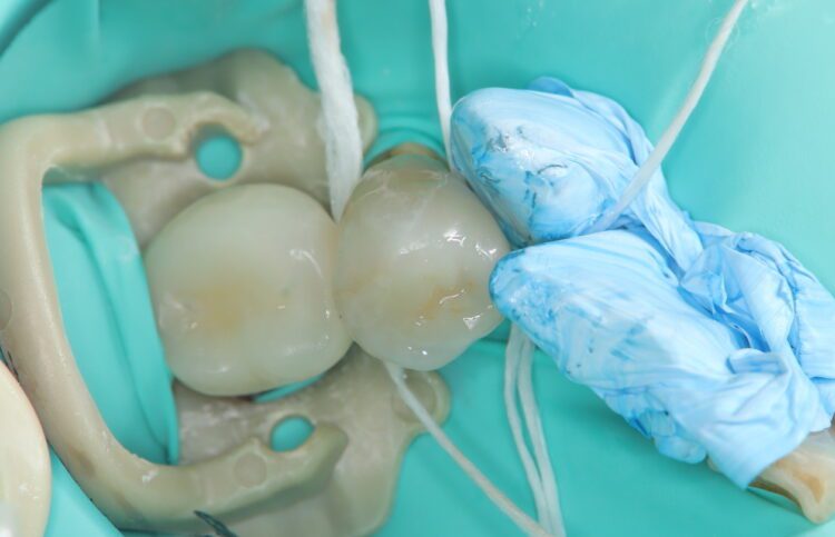 乱ぐい歯の虫歯治療 治療途中画像