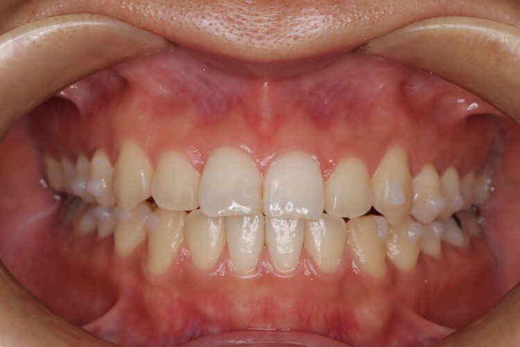 インビザラインで受け口を治したい 治療途中画像