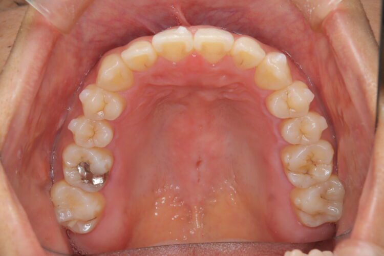 インビザラインで受け口を治したい 治療途中画像