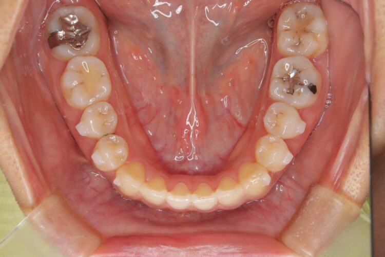 インビザラインで受け口を治したい 治療途中画像