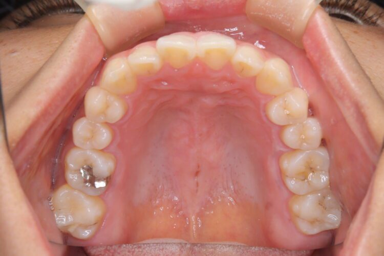 インビザラインで受け口を治したい 治療前画像