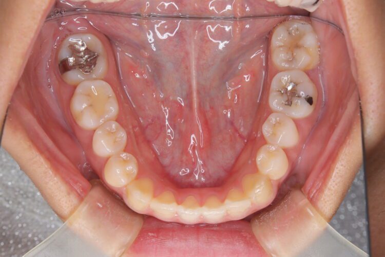 インビザラインで受け口を治したい 治療前画像