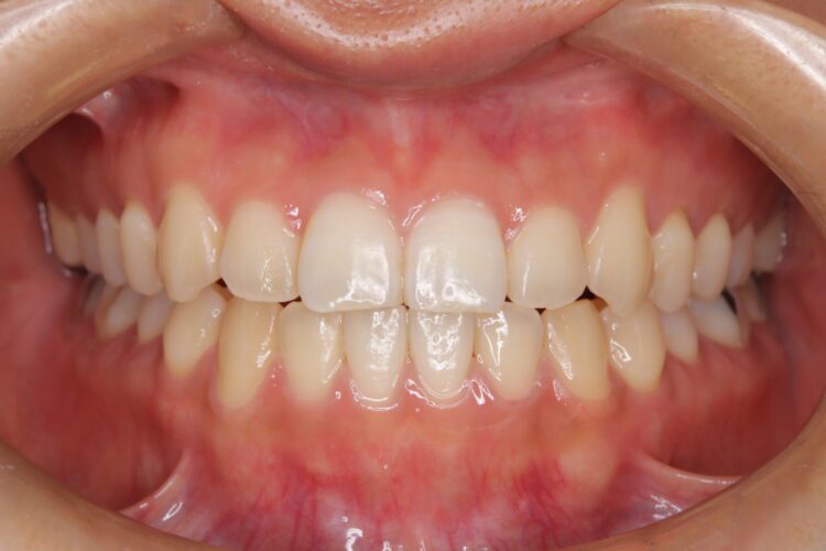 インビザラインで受け口を治したい 治療後画像