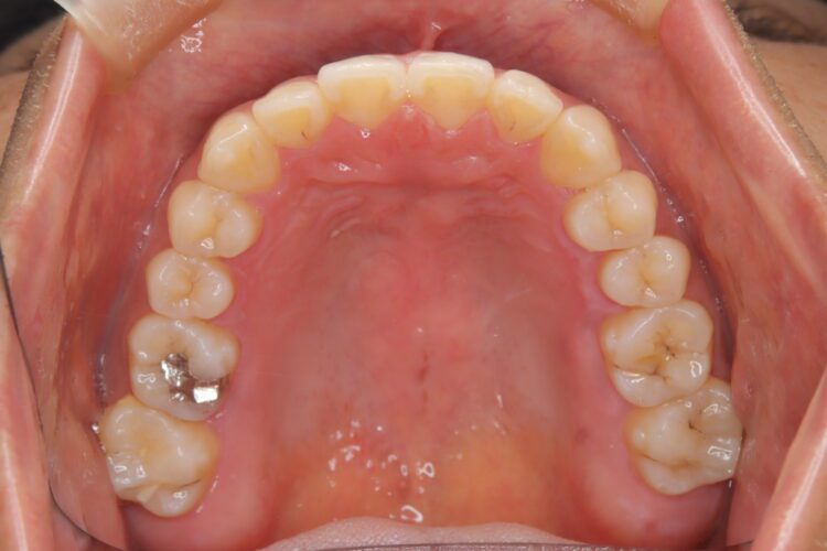 インビザラインで受け口を治したい 治療後画像