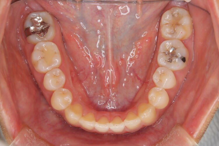 インビザラインで受け口を治したい 治療後画像
