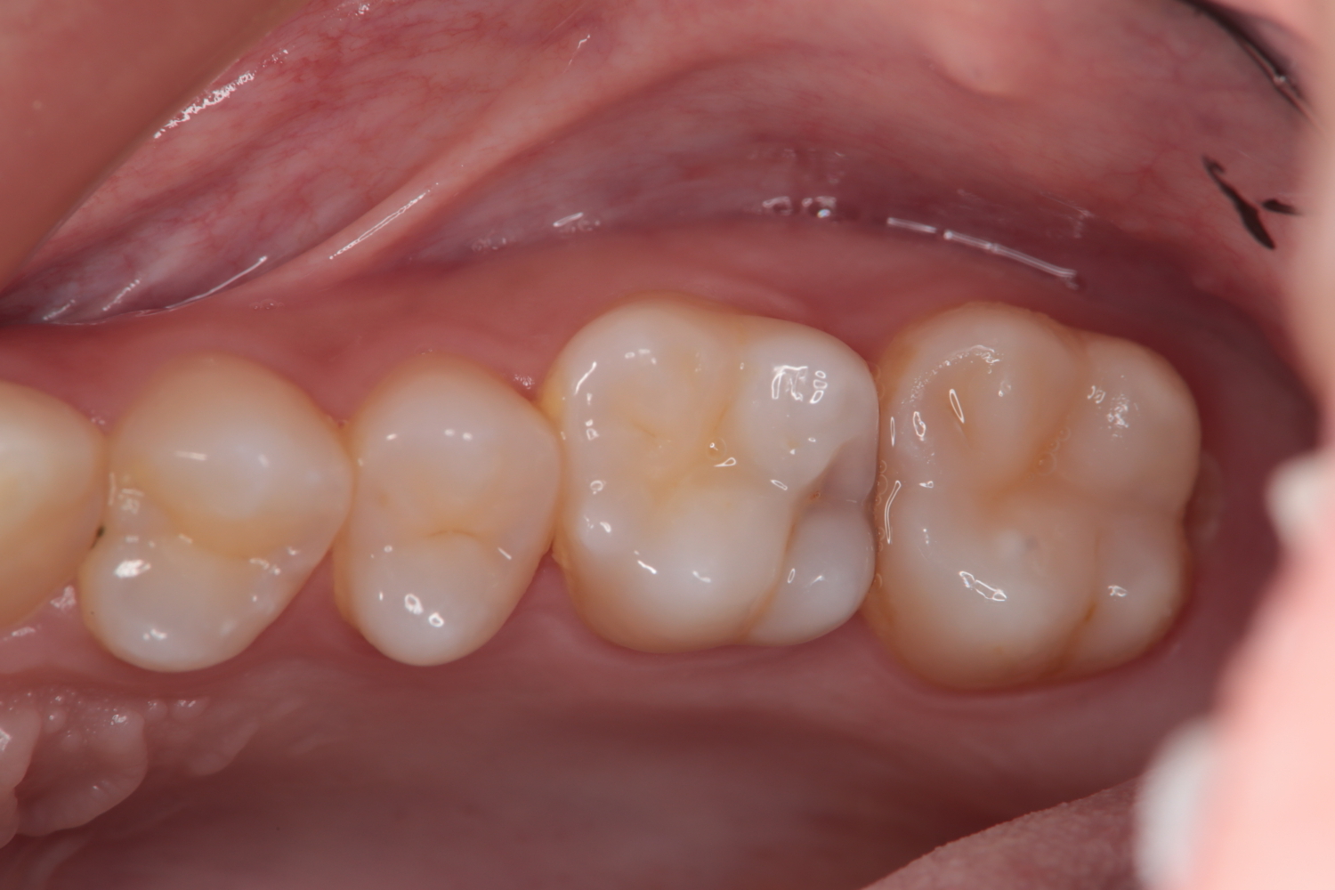 親知らずが痛むと思ったら別の部位に虫歯を発見 治療前