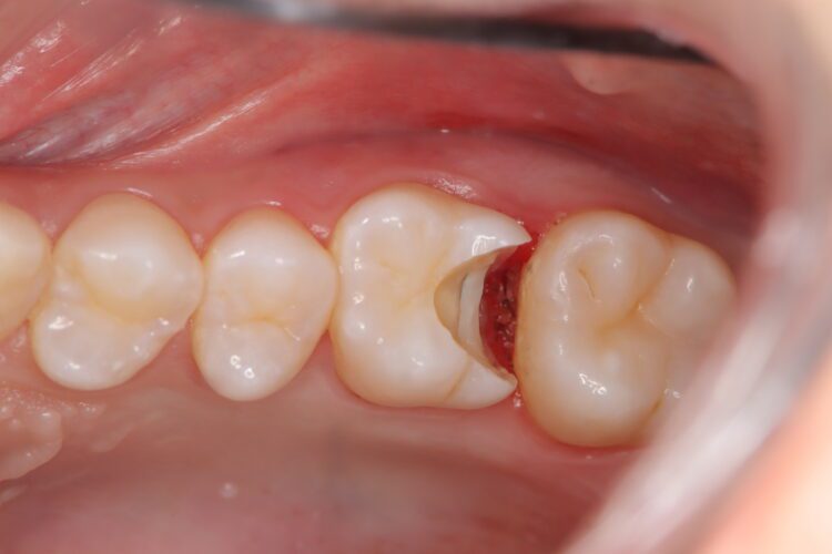 親知らずが痛むと思ったら別の部位に虫歯を発見 治療途中画像