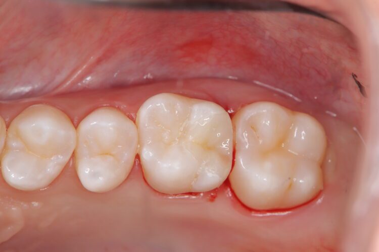 親知らずが痛むと思ったら別の部位に虫歯を発見 治療後画像